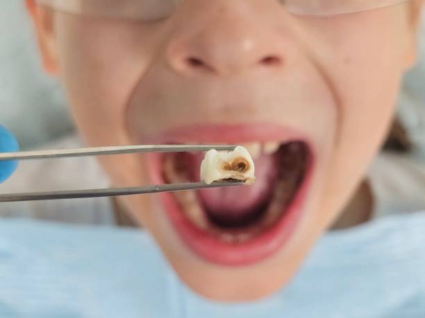 Best Dentist for Tooth Abscess  in Krum, TX